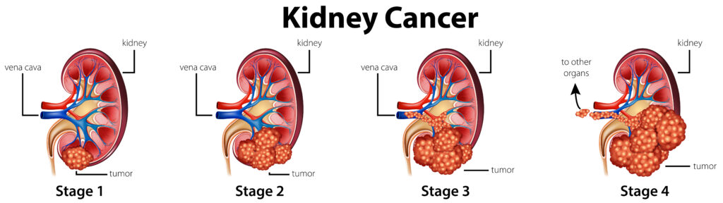 About Kidney Cancer In 2024