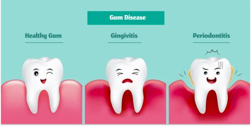Gum Disease