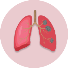 Adenocarcinoma