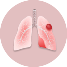 Carcinoid Tumors