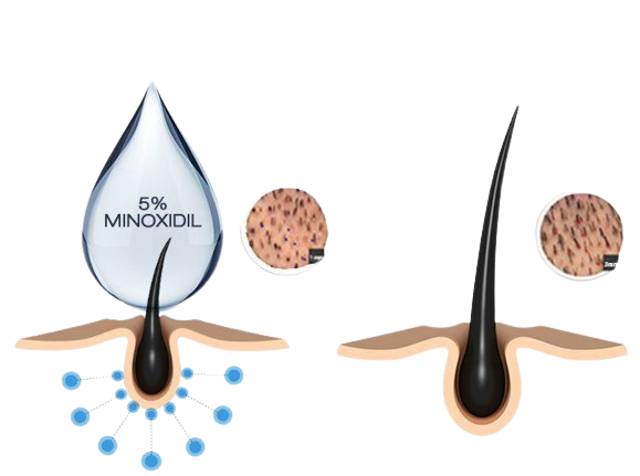 Minoxidil 
