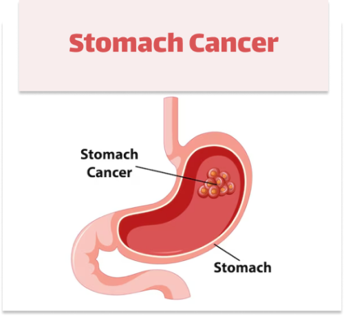 Stomach Cancer