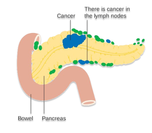 Diabetes And Pancreatic
