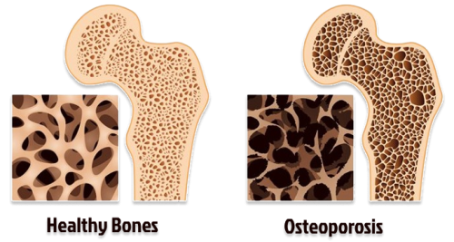Osteoporosis