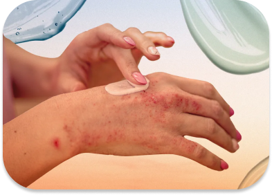 Psoriasis 
