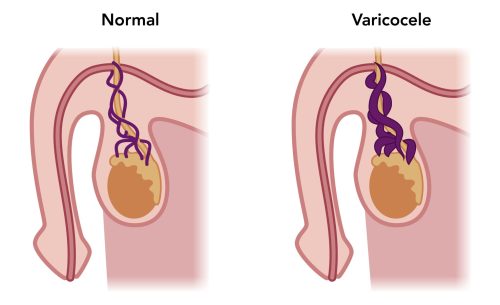 Varicocele