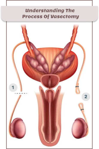 Vasectomy