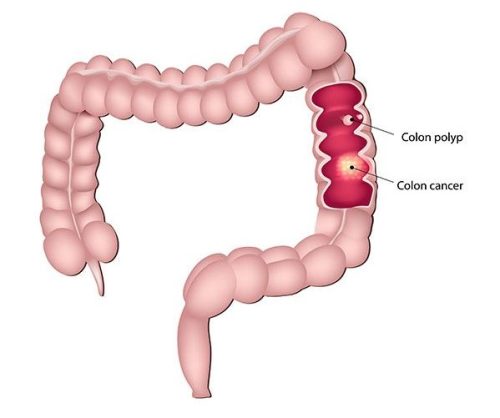 Colon Cancer