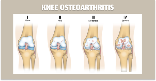 Knee Osteoarthritis