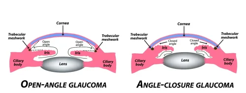Types Of Glaucoma