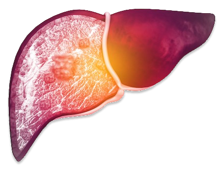 Fatty Liver Disease