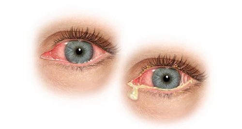 How Doxycycline Can Help Treat Eye Infections 3 Effects Against Conjunctivitis