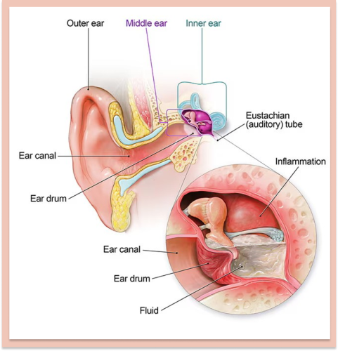 Ear Infections