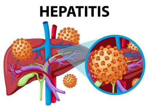 Hepatitis C