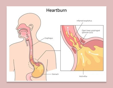 Heartburn Prevention