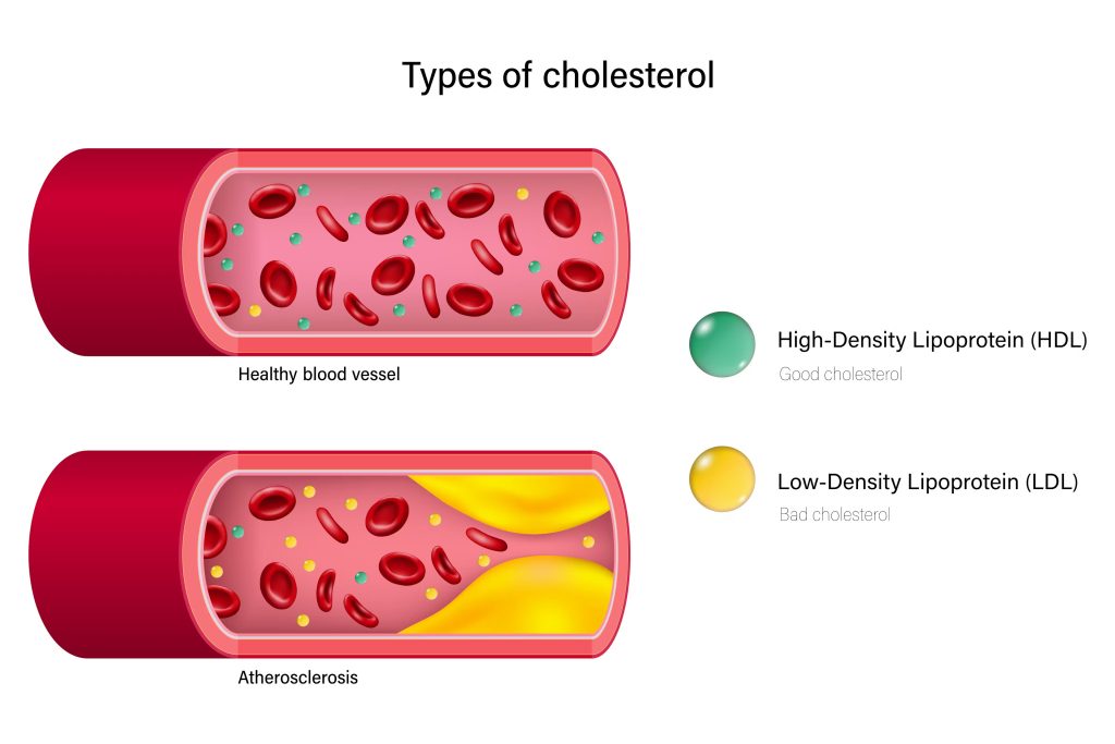 High Cholesterol