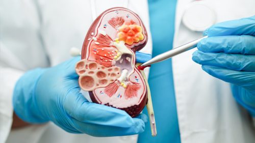 Kidney Stones
