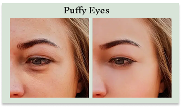 Puffy Eyes