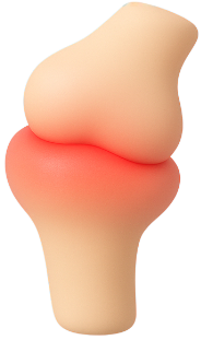 Swelling At Joints